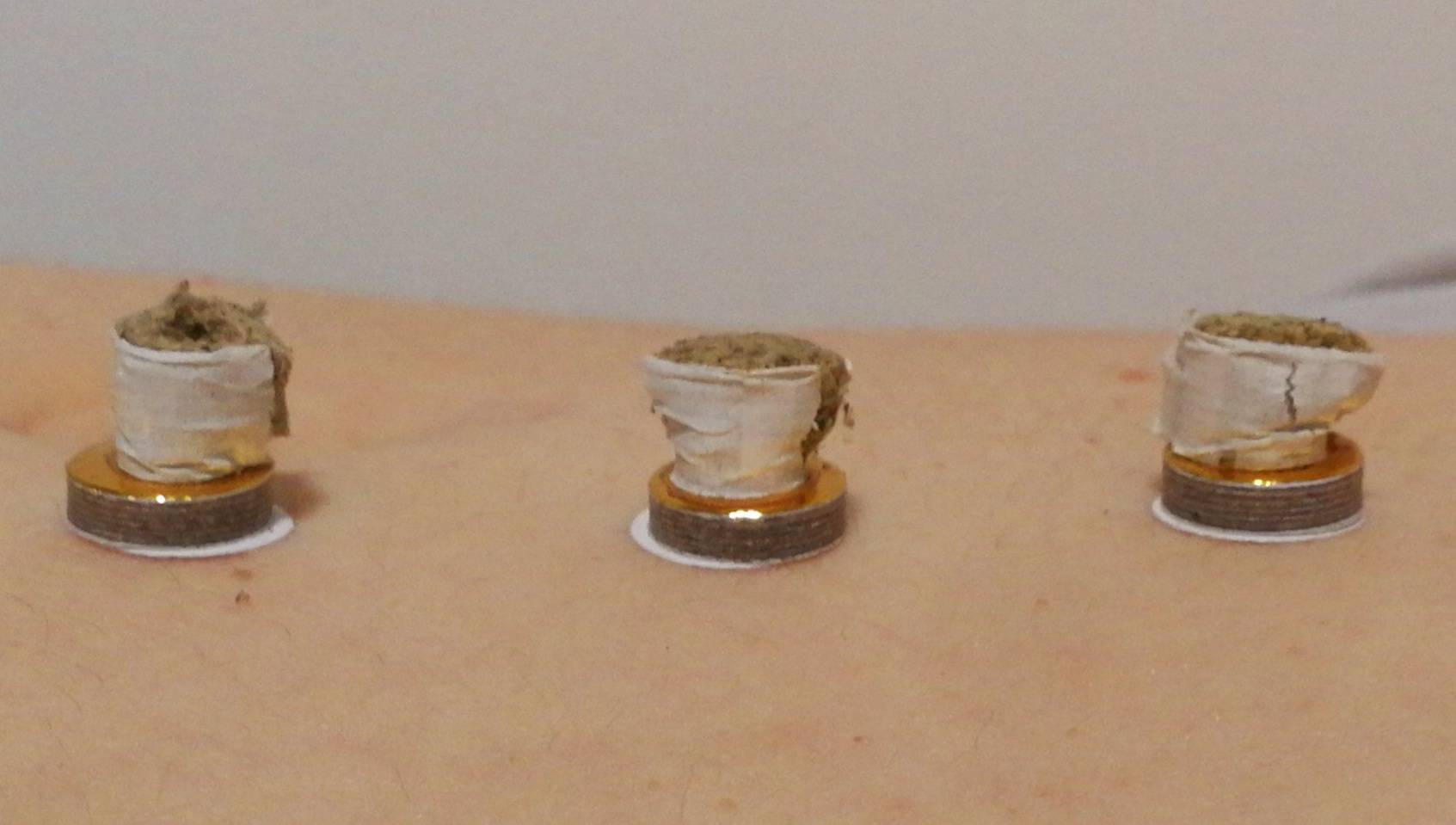 Moxibustion am Bauch