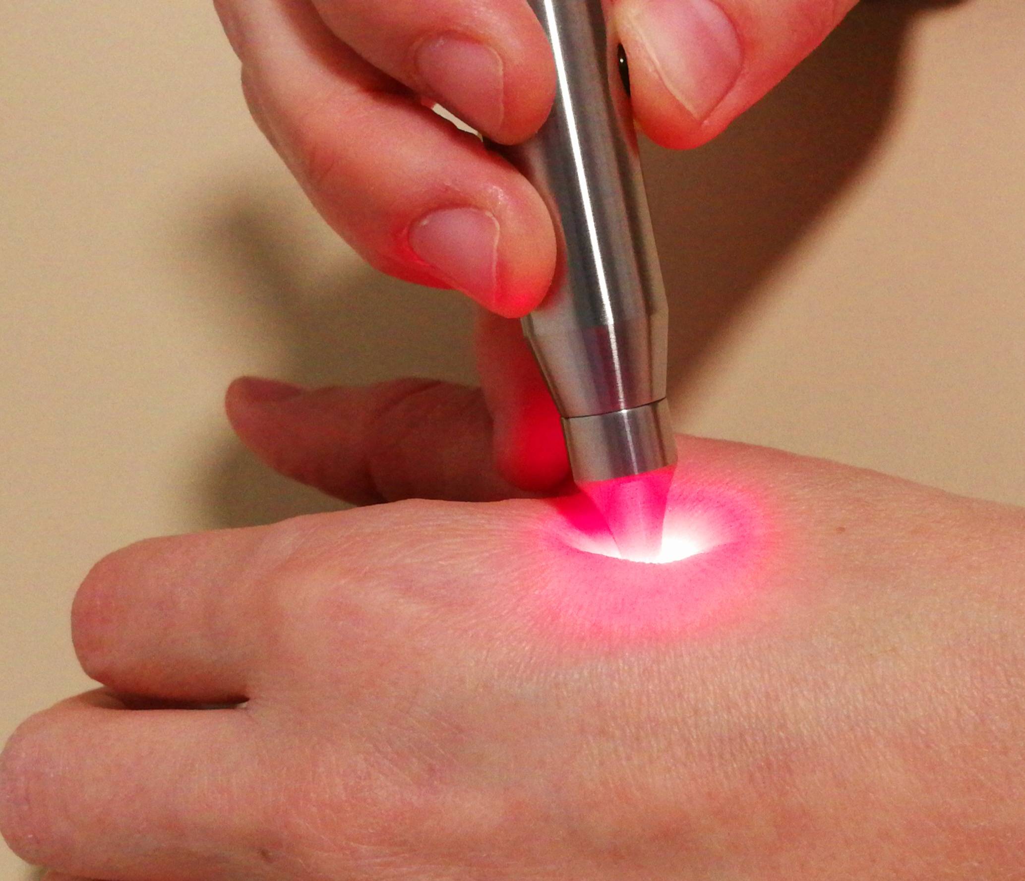 Softlaserbehandlung an der Hand