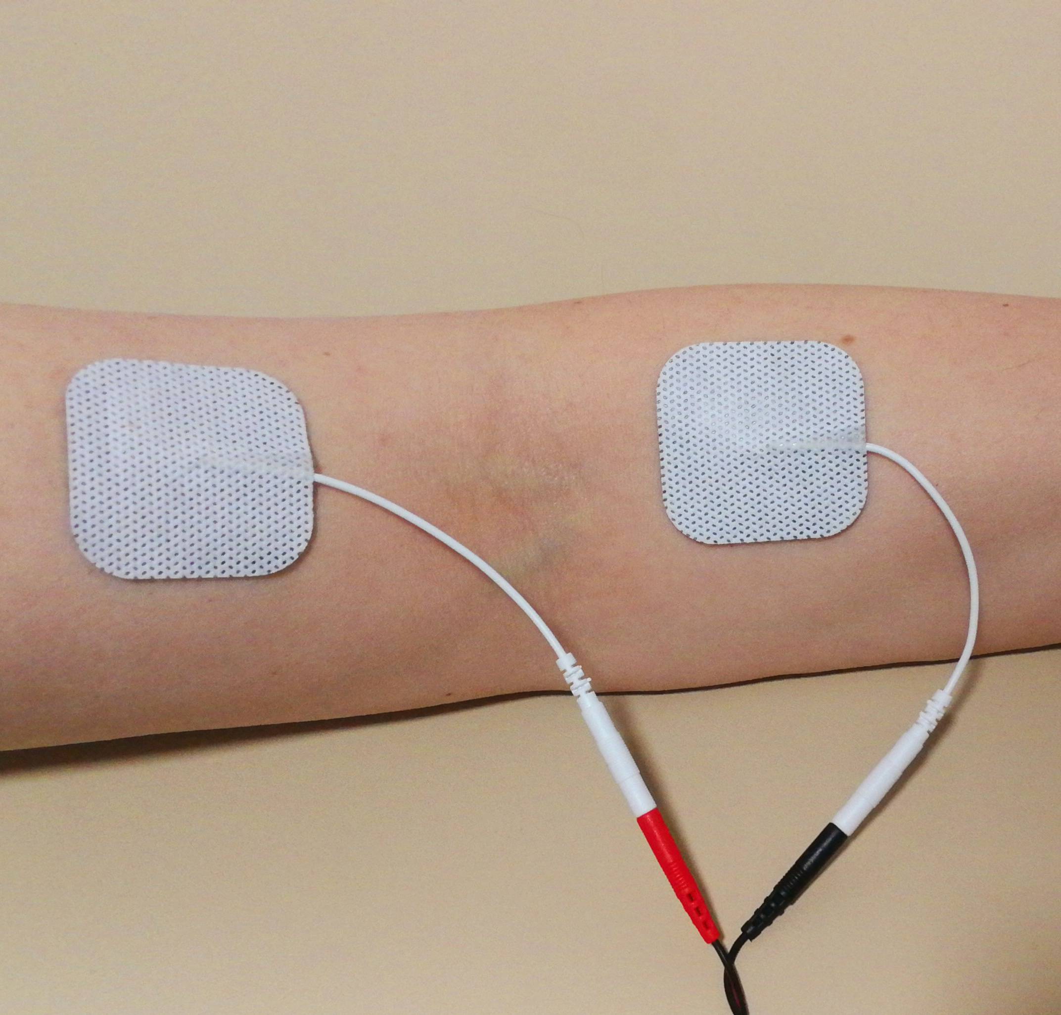TENS-Anlage am Arm